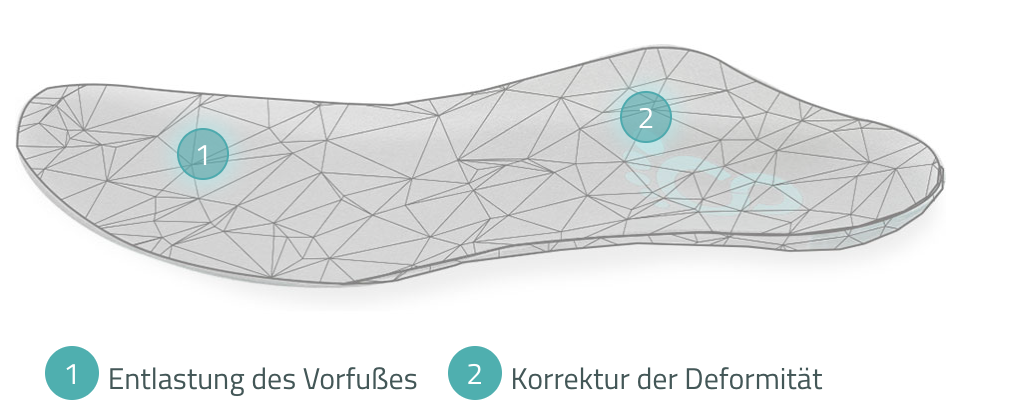 Custom orthopaedic insole by Cordewener for splayfoot, relieving the forefoot